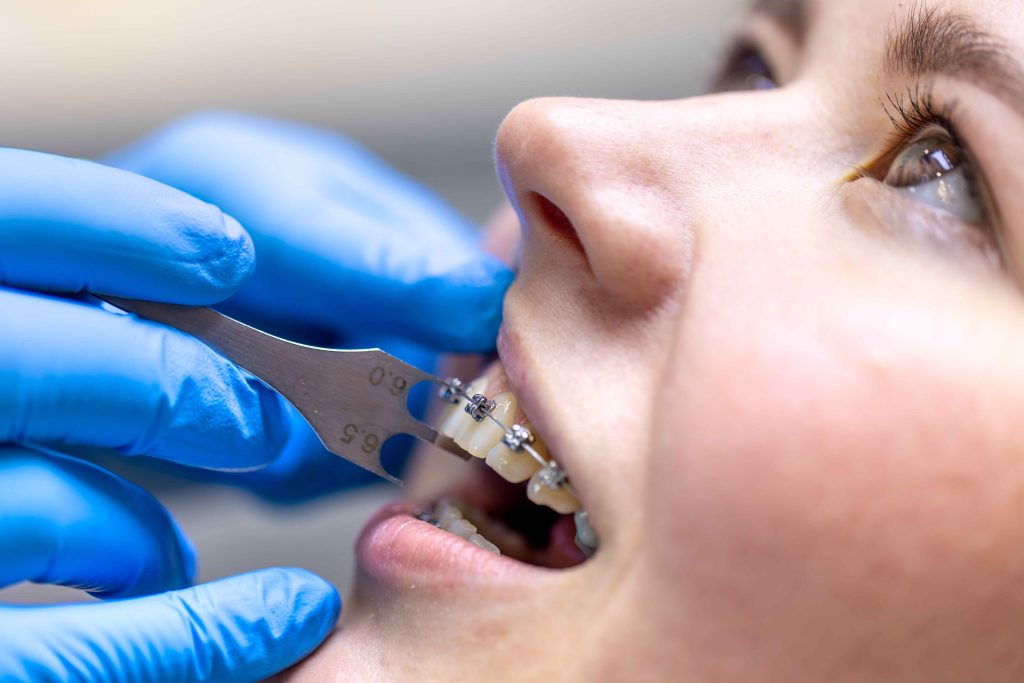 What To Know Before Choosing Single Braces For Teeth