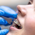 What To Know Before Choosing Single Braces For Teeth